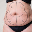 Tummy Tuck Surgery